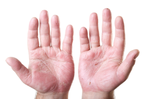  Egzama (Dermatit) nedir? Nasıl Tedavi Edilir?